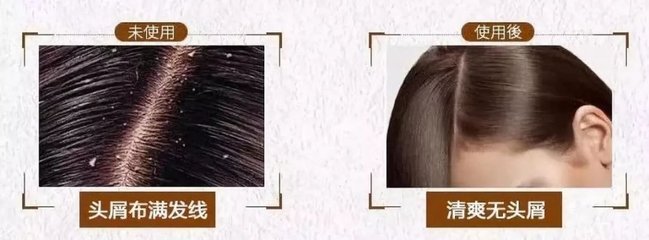 脫發、掉發、頭發稀少？用它洗洗，一次就離不開